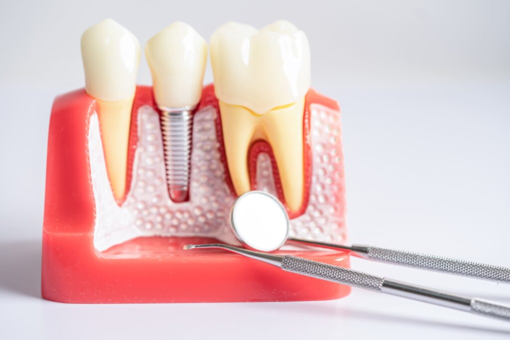 Imagen detallada de un implante dental de titanio colocado en el hueso maxilar