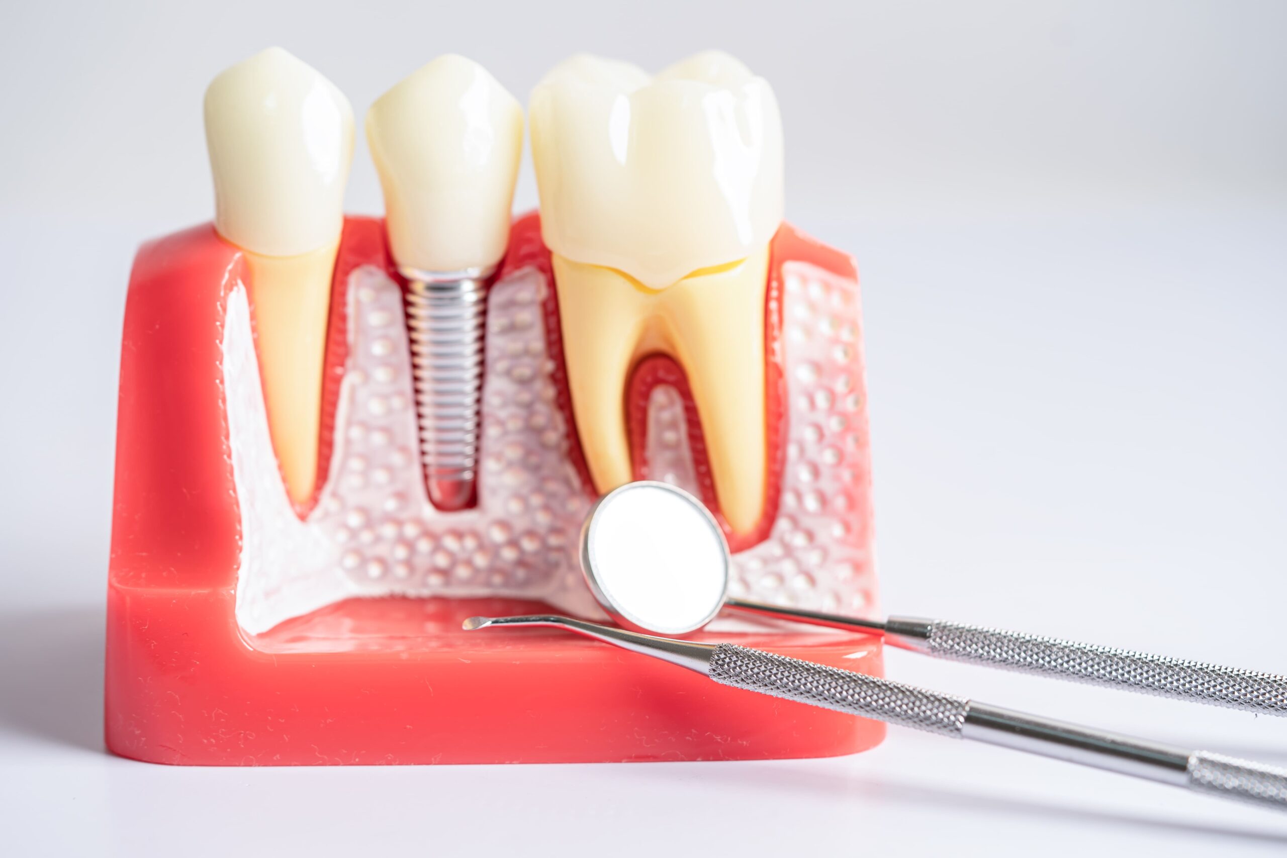 Imagen detallada de un implante dental de titanio colocado en el hueso maxilar