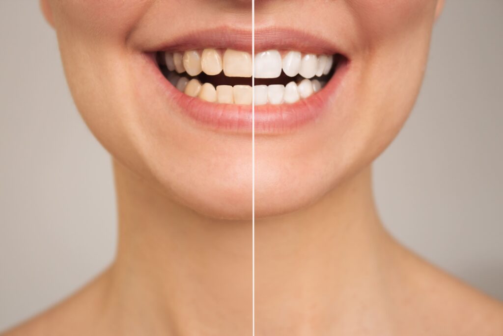 Comparación antes y después del blanqueamiento dental con dientes visiblemente más blancos