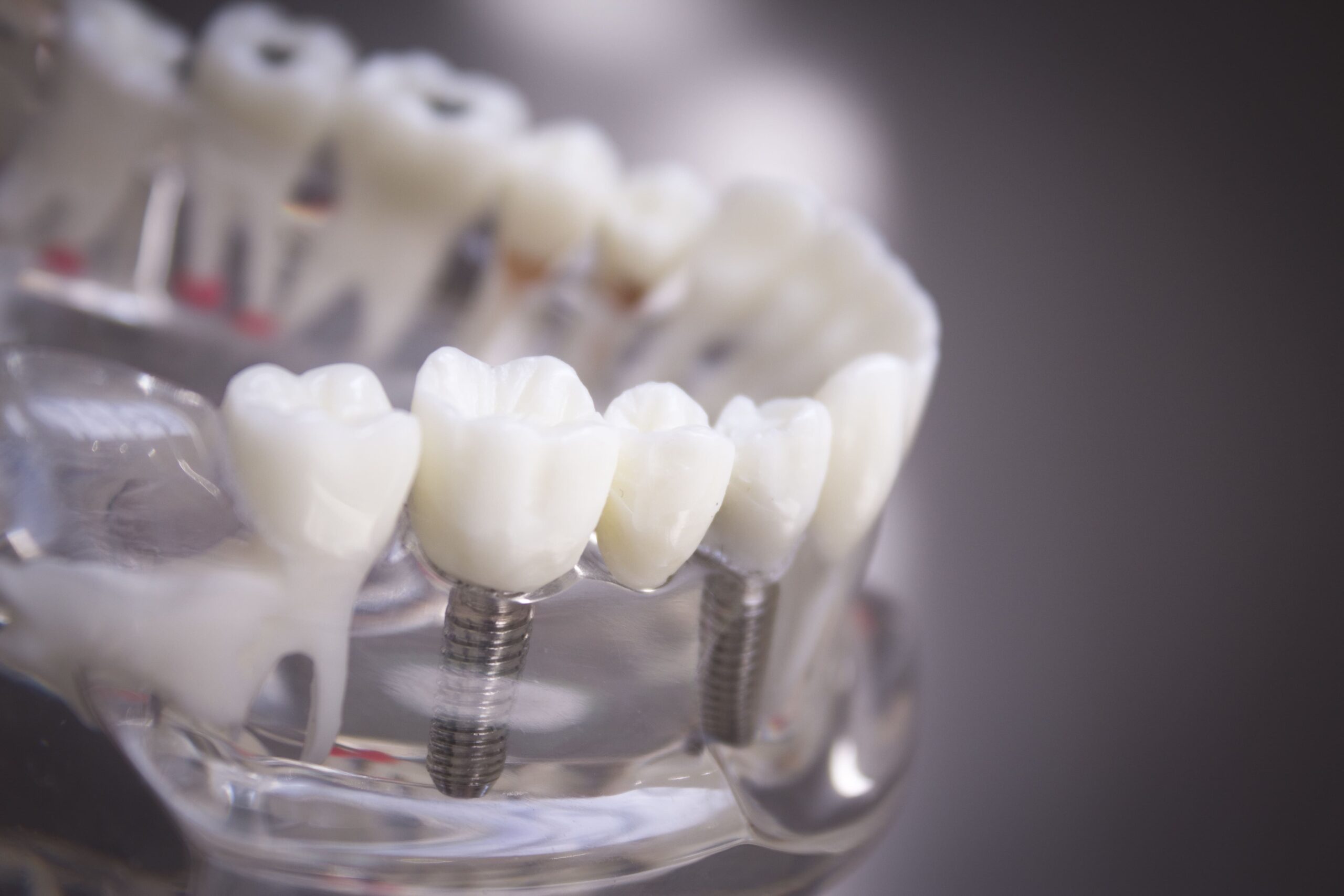 Maqueta dental con implantes dentales que muestra cómo se integran en el hueso para sustituir dientes perdidos de forma natural y duradera.