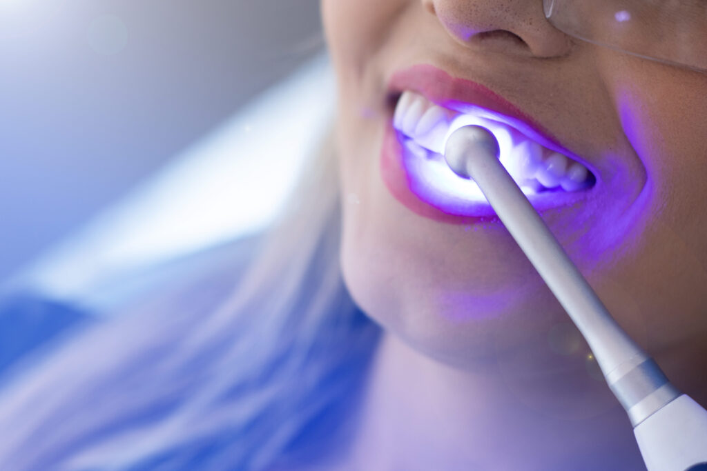 Paciente recibiendo un blanqueamiento dental con luz LED en una clínica, durante un procedimiento estético supervisado por un especialista.