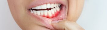 Mujer mostrando encías enrojecidas e inflamadas, signo de enfermedad periodontal.