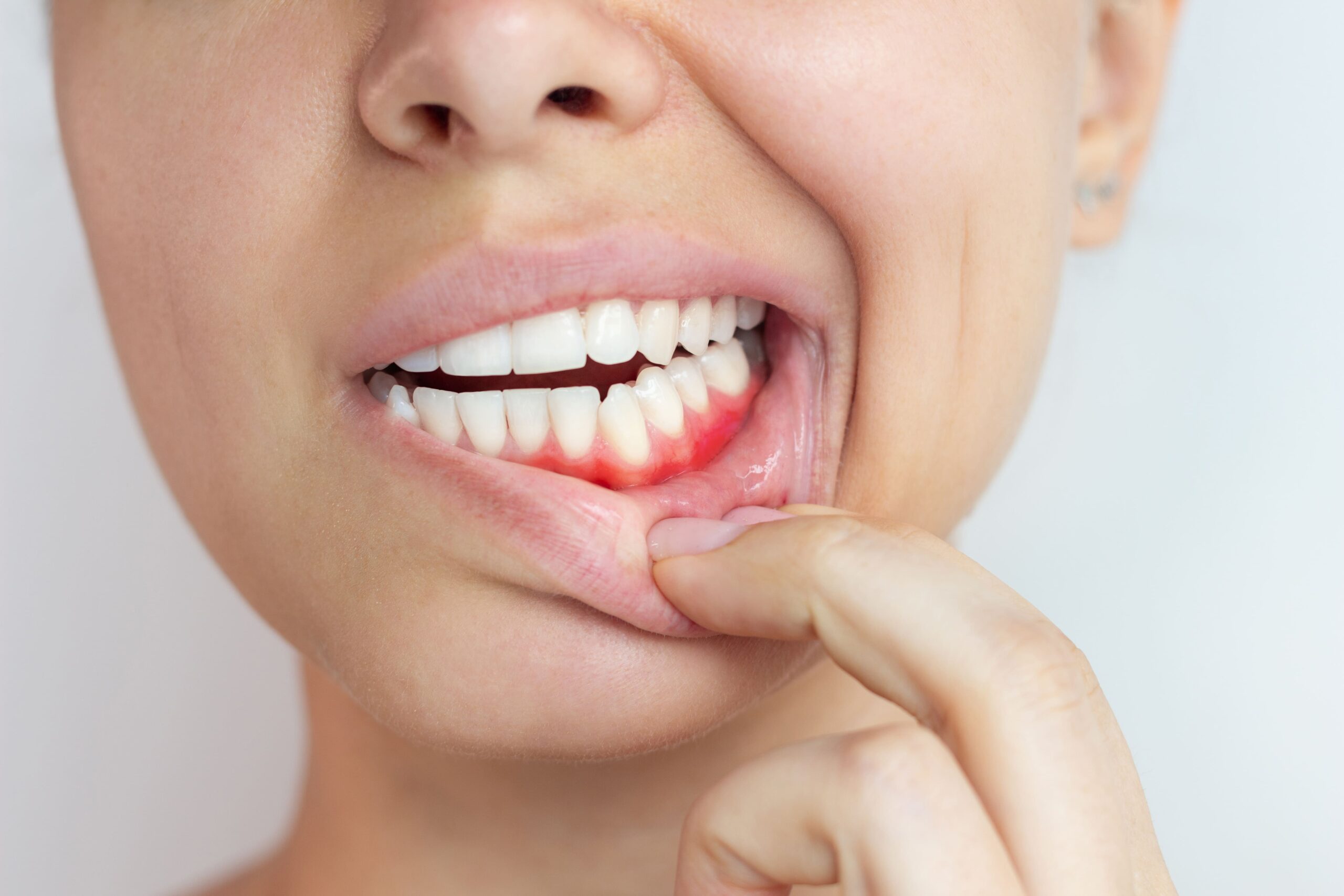 Mujer mostrando encías enrojecidas e inflamadas, signo de enfermedad periodontal.