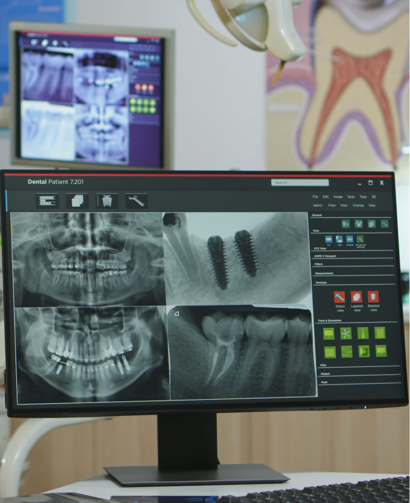 Software de planificación digital con radiografías dentales y ortopantomografía para implantes en clínica dental en Murcia