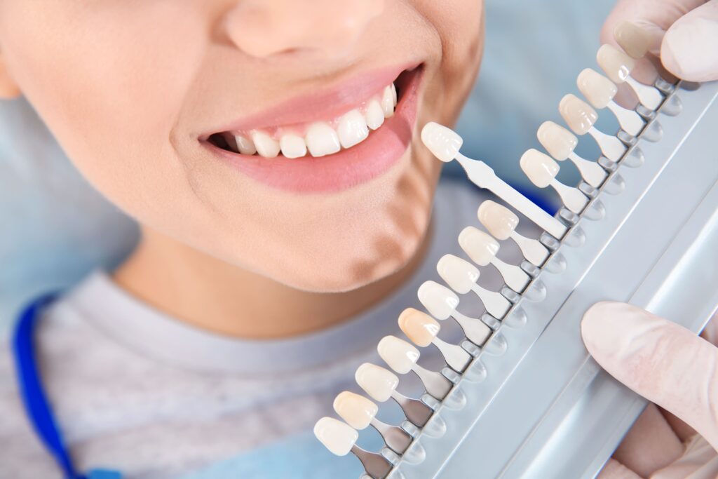 Blanqueamiento dental en clinica. Comprobación de que color es el indicado