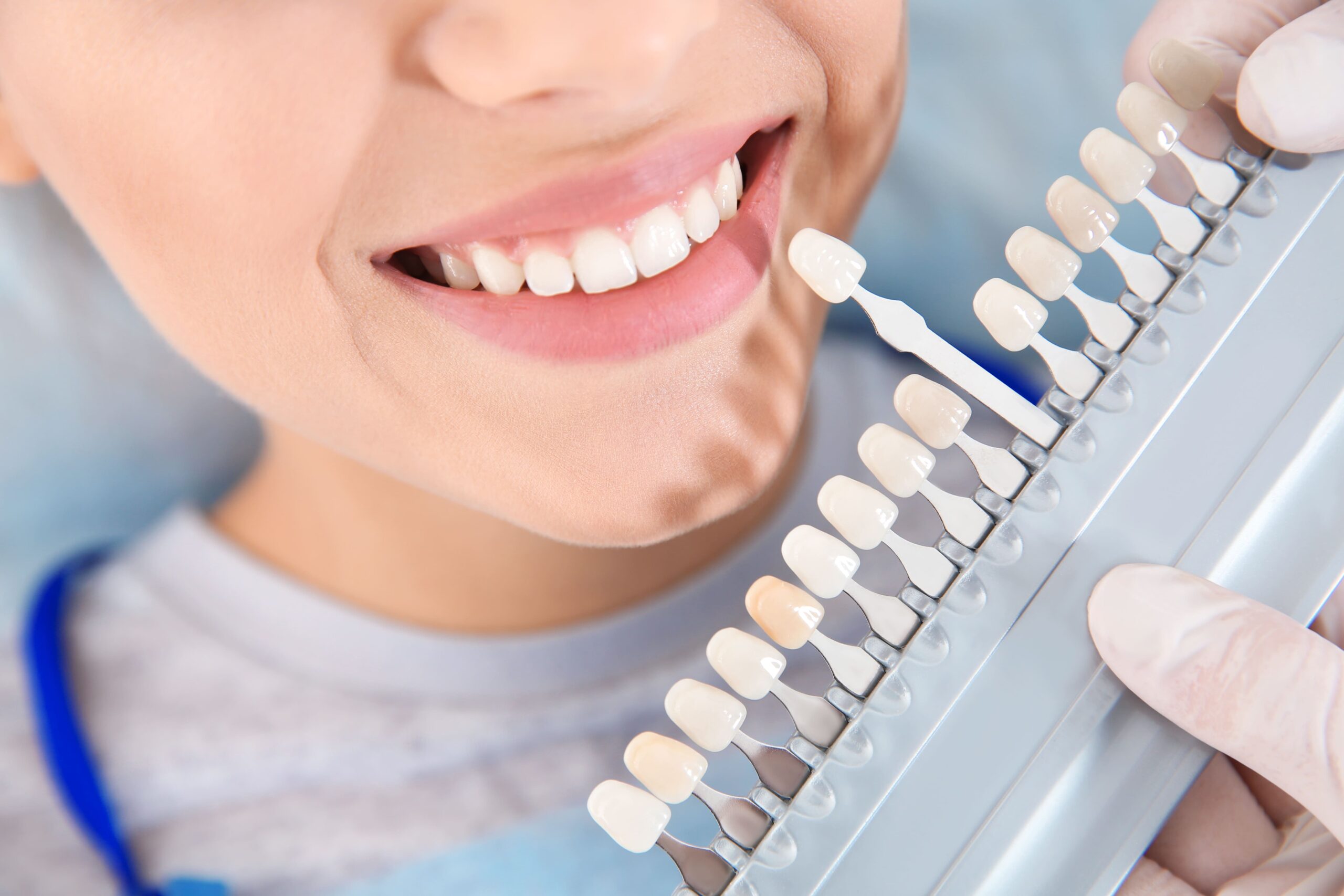 Blanqueamiento dental en clinica. Comprobación de que color es el indicado